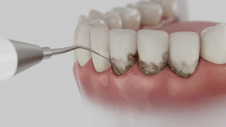 Trusted Wisdom Tooth Removal service in Granite Falls, MN - Dentist Open Now